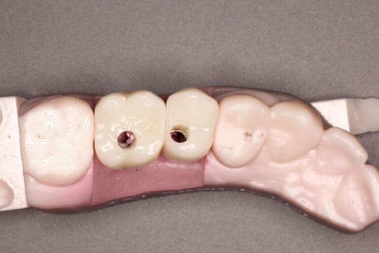 Dental Implants