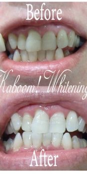 whitening35